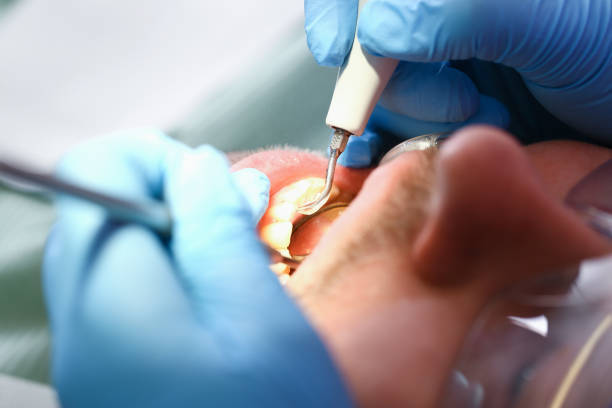 Best Emergency Wisdom Tooth Extraction in Fort Lauderdale, FL